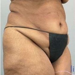 Tummy Tuck Before & After Patient #346