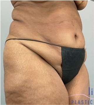 Tummy Tuck Before & After Patient #346