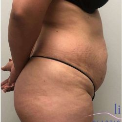 Tummy Tuck Before & After Patient #357
