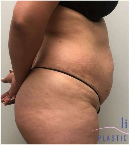 Tummy Tuck Before & After Patient #357