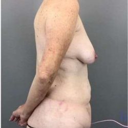 Tummy Tuck Before & After Patient #368