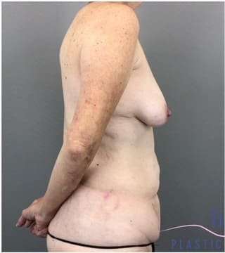 Tummy Tuck Before & After Patient #368