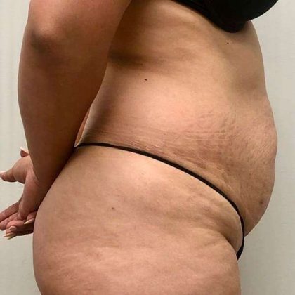 Tummy Tuck Before & After Patient #379