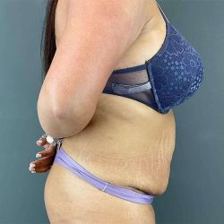 Tummy Tuck Before & After Patient #390