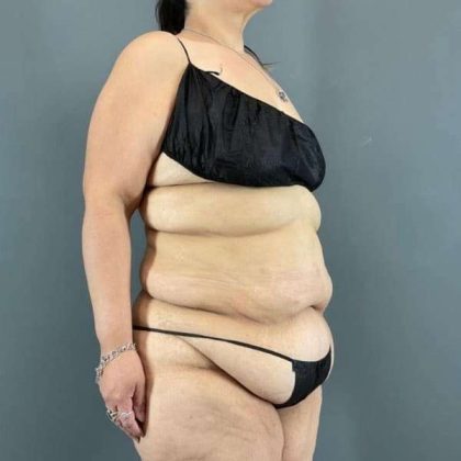 Tummy Tuck Before & After Patient #401