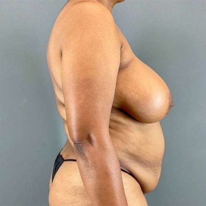 Tummy Tuck Before & After Patient #412
