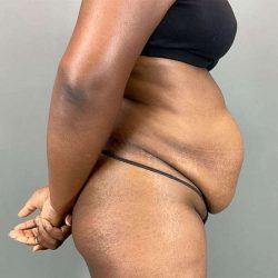 Tummy Tuck Before & After Patient #423