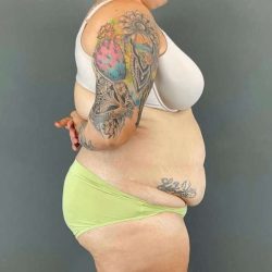 Tummy Tuck Before & After Patient #434