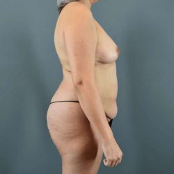Tummy Tuck Before & After Patient #445