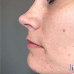 Injectables&Fillers Before & After Patient #140