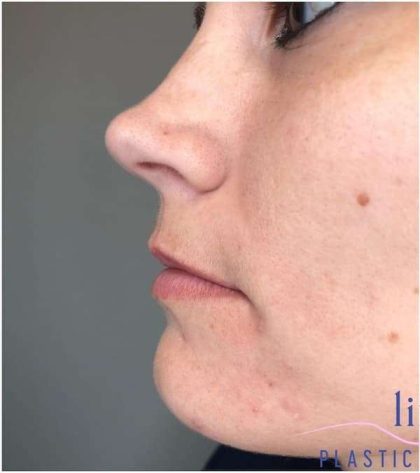 Injectables&Fillers Before & After Patient #140