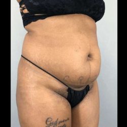 Tummy Tuck Before & After Patient #454
