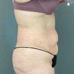 Tummy Tuck Before & After Patient #476