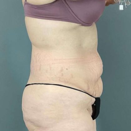 Tummy Tuck Before & After Patient #476