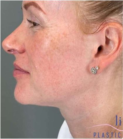 Injectables&Fillers Before & After Patient #118
