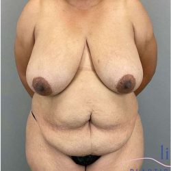 Tummy Tuck Before & After Patient #487