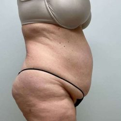 Tummy Tuck Before & After Patient #498