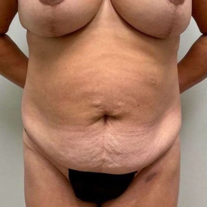 Tummy Tuck Before & After Patient #509