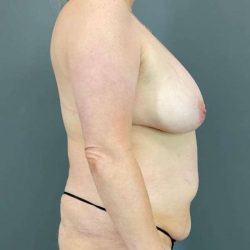 Tummy Tuck Before & After Patient #520