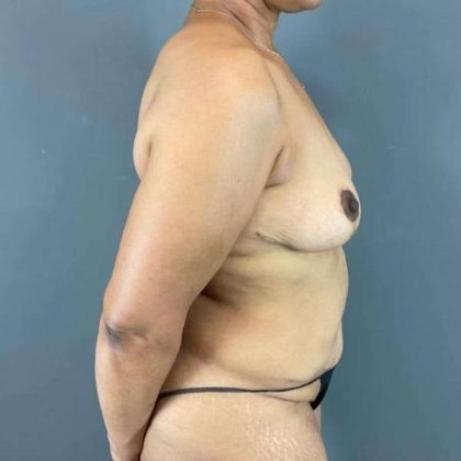 Tummy Tuck Before & After Patient #542