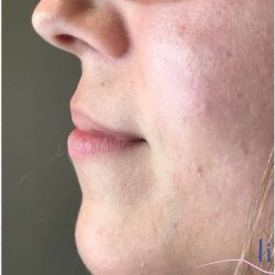 Injectables&Fillers Before & After Patient #145