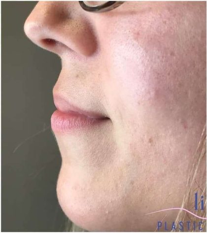 Injectables&Fillers Before & After Patient #145