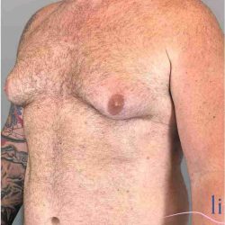 Gynecomastia Before & After Patient #560