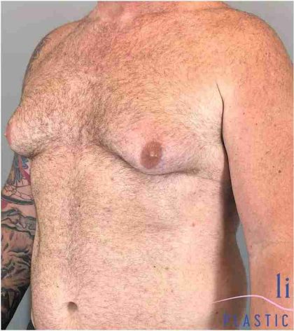 Gynecomastia Before & After Patient #560