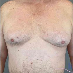 Gynecomastia Before & After Patient #571