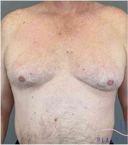 Gynecomastia Before & After Patient #571