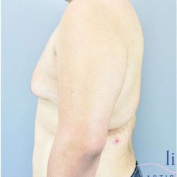 Gynecomastia Before & After Patient #582