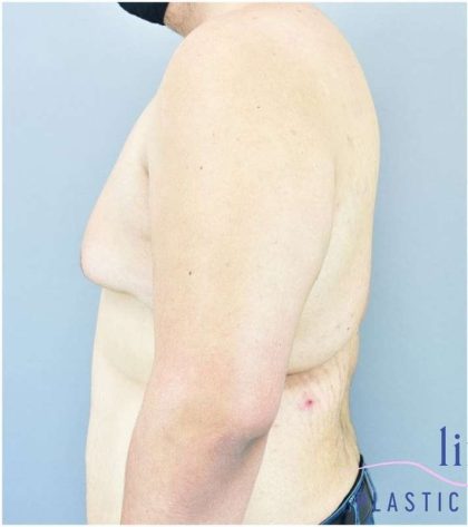 Gynecomastia Before & After Patient #582
