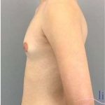 Gynecomastia Before & After Patient #593