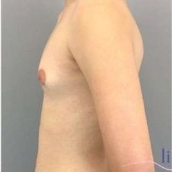 Gynecomastia Before & After Patient #593
