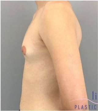 Gynecomastia Before & After Patient #593