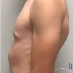 Gynecomastia Before & After Patient #604