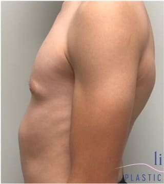 Gynecomastia Before & After Patient #604