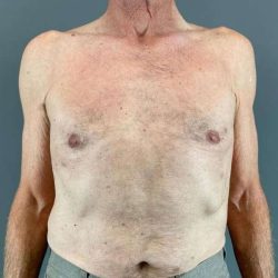 Gynecomastia Before & After Patient #611