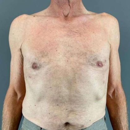 Gynecomastia Before & After Patient #611