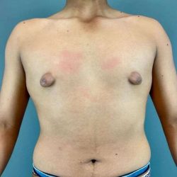 Gynecomastia Before & After Patient #622