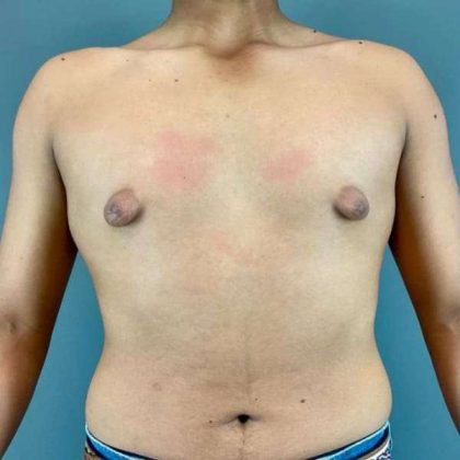 Gynecomastia Before & After Patient #622