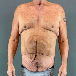 Gynecomastia Before & After Patient #629