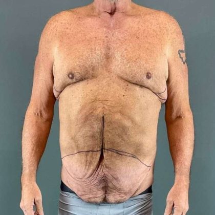 Gynecomastia Before & After Patient #629