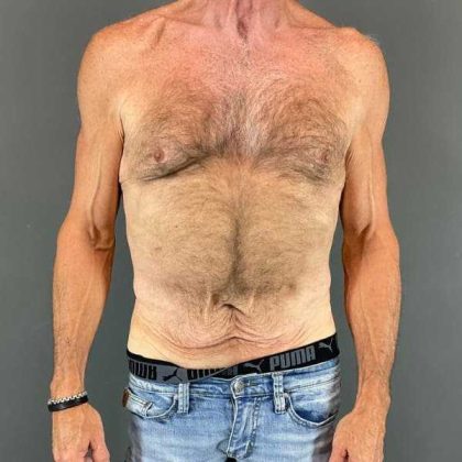Gynecomastia Before & After Patient #642
