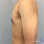 Gynecomastia Before & After Patient #653