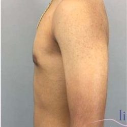 Gynecomastia Before & After Patient #653