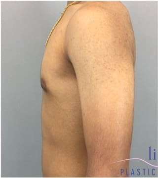 Gynecomastia Before & After Patient #653