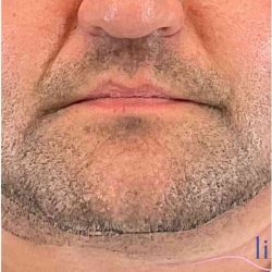 Injectables&Fillers Before & After Patient #150