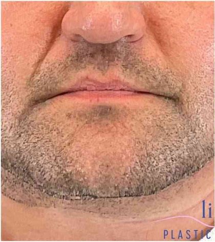 Injectables&Fillers Before & After Patient #150