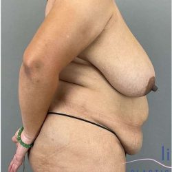 Breast Reduction Before & After Patient #664
